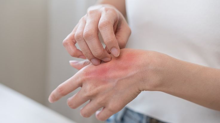 Eczema Treatment