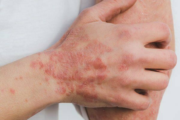 Psoriasis Treatment